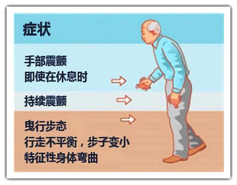 经颅磁刺激仪治疗帕金森有效果吗